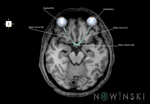 G6.T26.V6.P-13S.Visual system–Triplanar