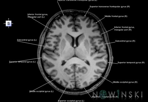 G6.T3.1.V5.P10.Cerebrum–Triplanar