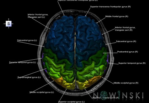 G6.T3.1.V5.P10S.Cerebrum–Triplanar