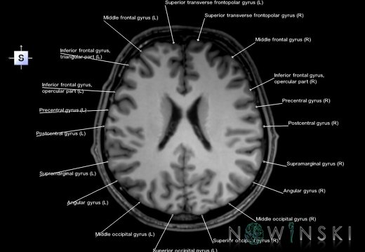 G6.T3.1.V5.P20.Cerebrum–Triplanar