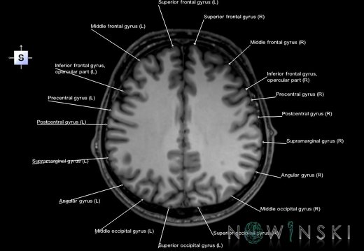 G6.T3.1.V5.P30.Cerebrum–Triplanar