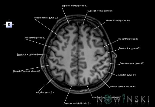 G6.T3.1.V5.P40.Cerebrum–Triplanar