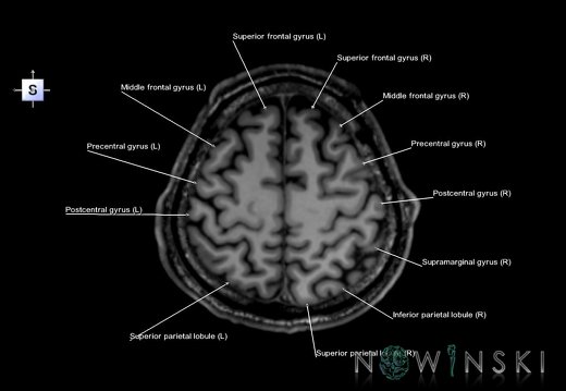 G6.T3.1.V5.P50.Cerebrum–Triplanar