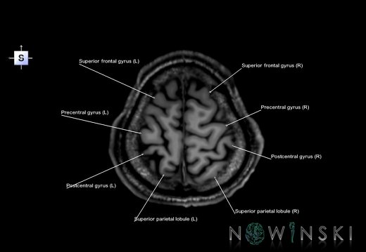 G6.T3.1.V5.P60.Cerebrum–Triplanar