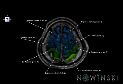 G6.T3.1.V5.P60S.Cerebrum–Triplanar