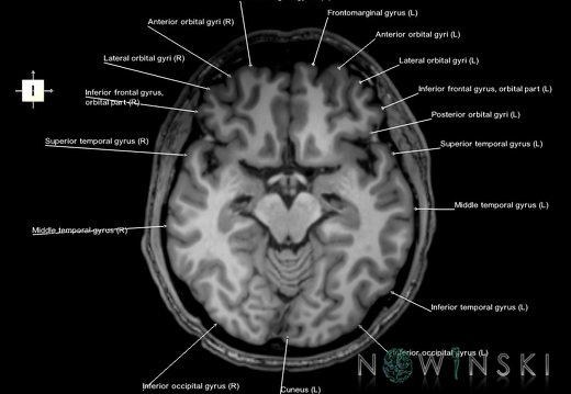 G6.T3.1.V6.P-10.Cerebrum–Triplanar