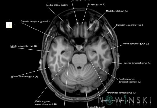 G6.T3.1.V6.P-20.Cerebrum–Triplanar