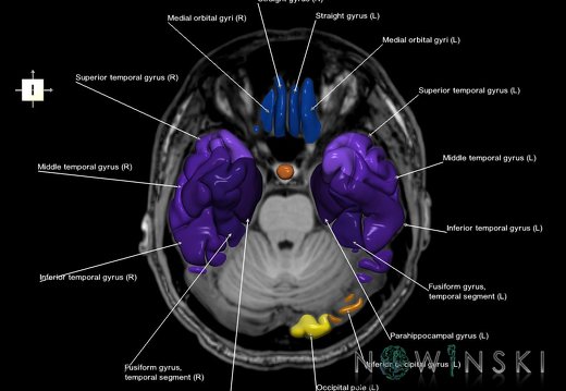 G6.T3.1.V6.P-20S.Cerebrum–Triplanar