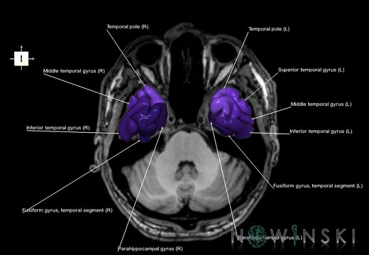 G6.T3.1.V6.P-30S.Cerebrum–Triplanar