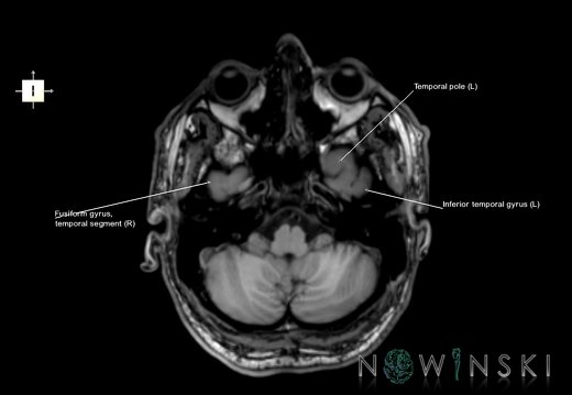 G6.T3.1.V6.P-40.Cerebrum–Triplanar