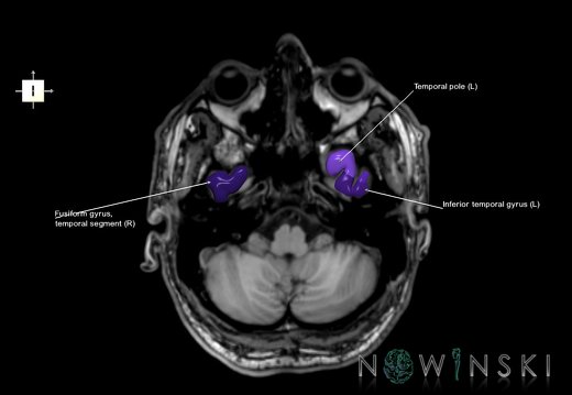 G6.T3.1.V6.P-40S.Cerebrum–Triplanar