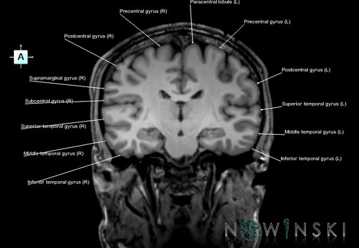 G6.T3.1.V1.P-20.Cerebrum–Triplanar