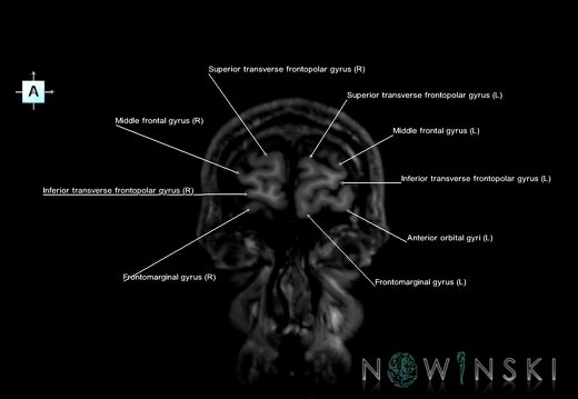 G6.T3.1.V1.P60.Cerebrum–Triplanar