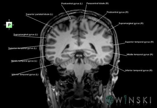 G6.T3.1.V3.P-40.Cerebrum–Triplanar