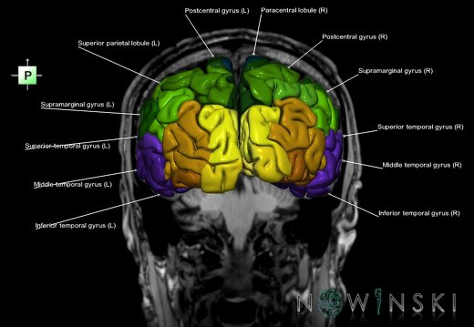 G6.T3.1.V3.P-40S.Cerebrum–Triplanar