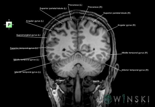 G6.T3.1.V3.P-50.Cerebrum–Triplanar