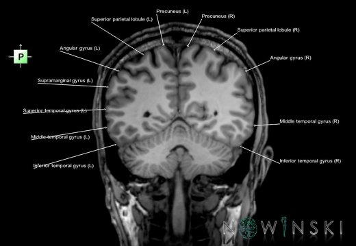 G6.T3.1.V3.P-50.Cerebrum–Triplanar