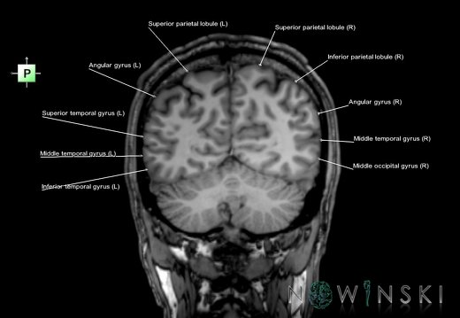 G6T3.1.Cerebrum–TriplanarCoronal