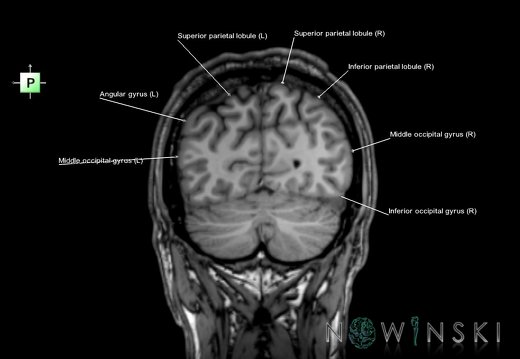 G6.T3.1.V3.P-70.Cerebrum–Triplanar