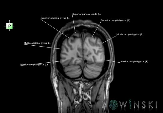 G6.T3.1.V3.P-80.Cerebrum–Triplanar