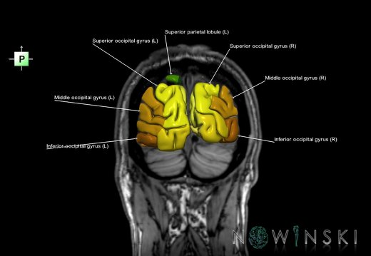 G6.T3.1.V3.P-80S.Cerebrum–Triplanar