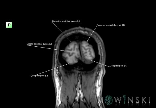 G6.T3.1.V3.P-90.Cerebrum–Triplanar