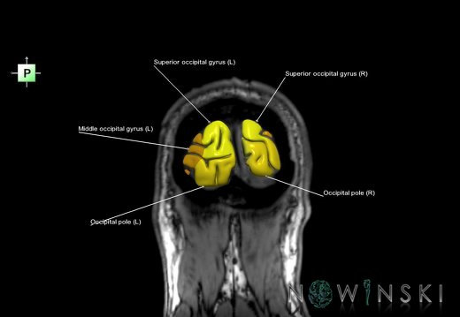 G6.T3.1.V3.P-90S.Cerebrum–Triplanar