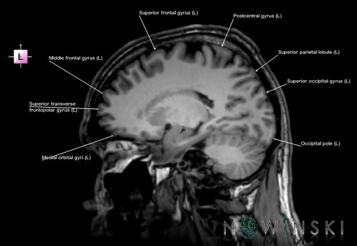 G6T3.1.Cerebrum–TriplanarSagittal