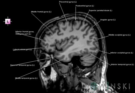 G6.T3.1.V2.P40.Cerebrum–Triplanar