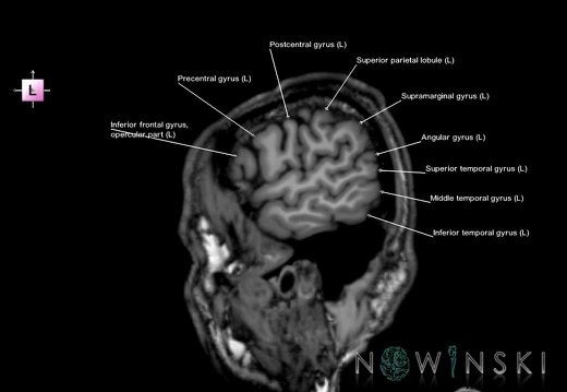 G6.T3.1.V2.P60.Cerebrum–Triplanar