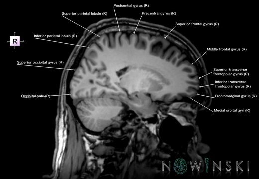 G6.T3.1.V4.P-20.Cerebrum–Triplanar