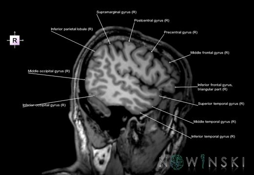 G6.T3.1.V4.P-50.Cerebrum–Triplanar