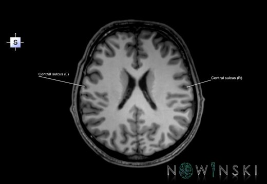 G6.T7.3.V5.P20.Central sulcus–Triplanar