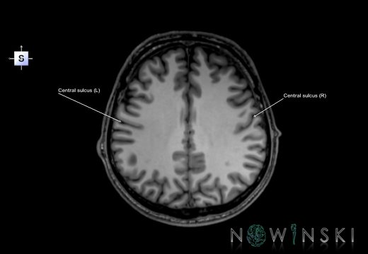 G6.T7.3.V5.P30.Central sulcus–Triplanar