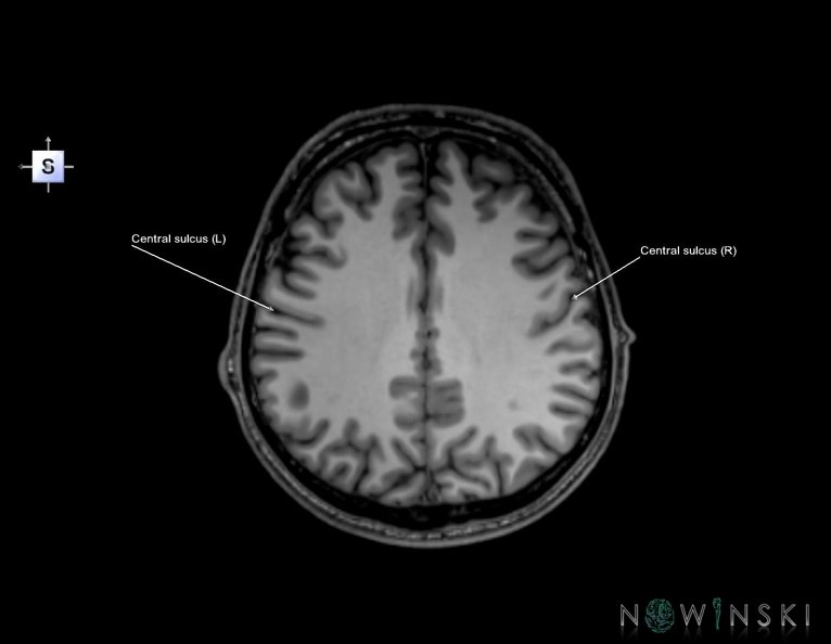 G6.T7.3.V5.P30.Central_sulcus–Triplanar.tiff