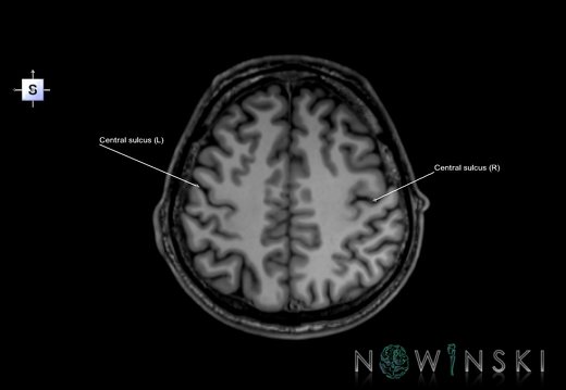 G6.T7.3.V5.P40.Central sulcus–Triplanar