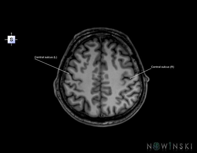 G6.T7.3.V5.P40.Central_sulcus–Triplanar.tiff