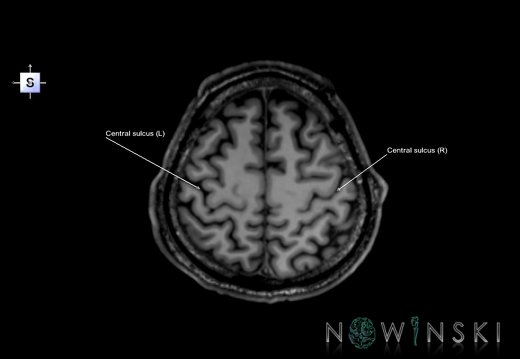 G6.T7.3.V5.P50.Central sulcus–Triplanar