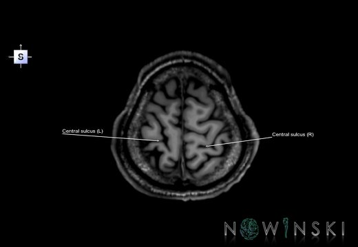 G6.T7.3.V5.P60.Central sulcus–Triplanar