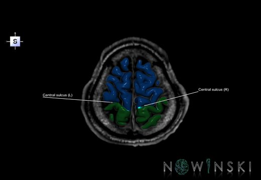 G6.T7.3.V5.P60S.Central sulcus–Triplanar