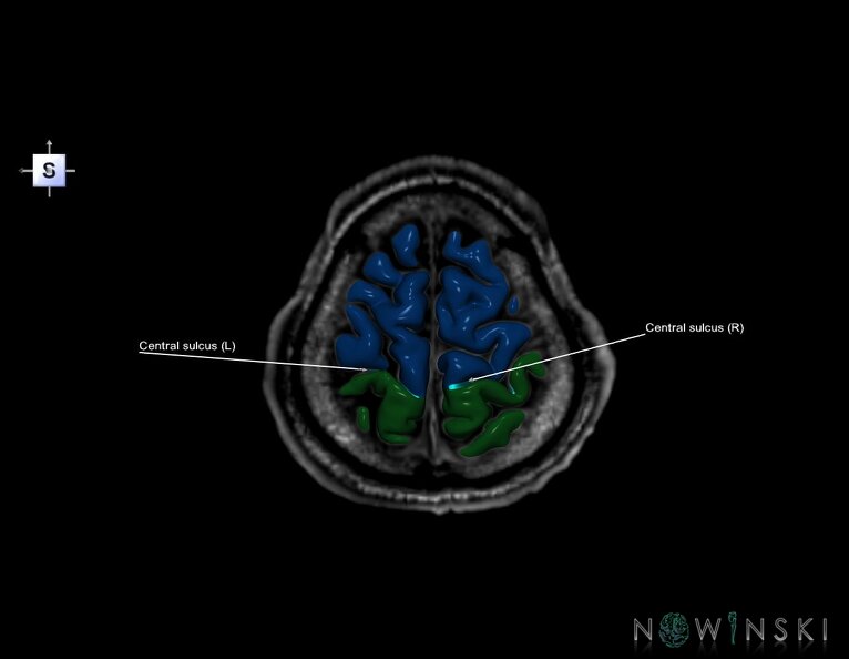 G6.T7.3.V5.P60S.Central_sulcus–Triplanar.tiff