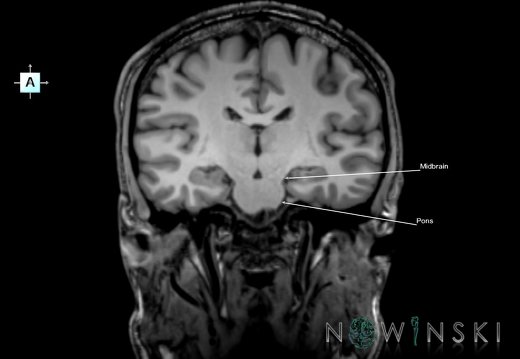 G6.T9.4.V1.P-20.Brainstem–Triplanar