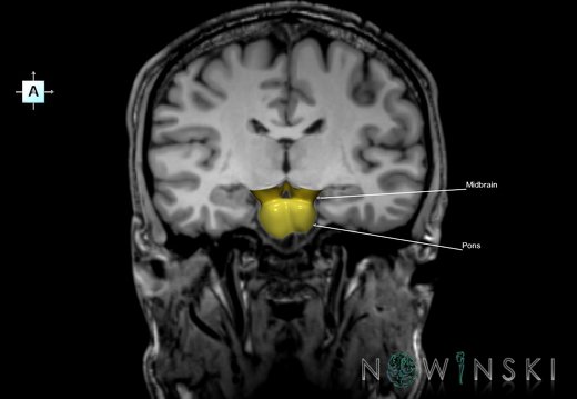 G6.T9.4.V1.P-20S.Brainstem–Triplanar