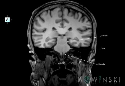 G6.T9.4.V1.P-30.Brainstem–Triplanar