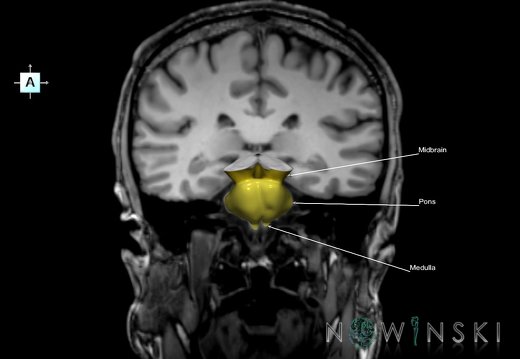 G6.T9.4.V1.P-30S.Brainstem–Triplanar