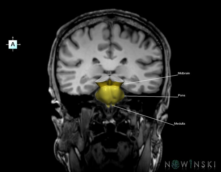 G6.T9.4.V1.P-30S.Brainstem–Triplanar.tiff