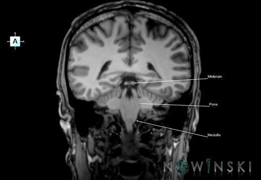 G6.T9.4.V1.P-40.Brainstem–Triplanar