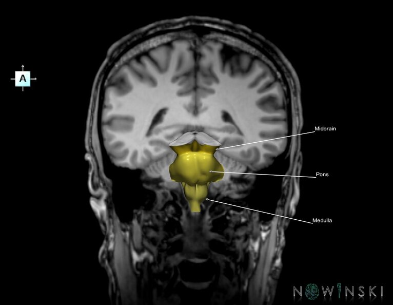 G6.T9.4.V1.P-40S.Brainstem–Triplanar.tiff