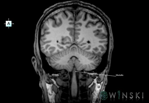G6.T9.4.V1.P-50.Brainstem–Triplanar