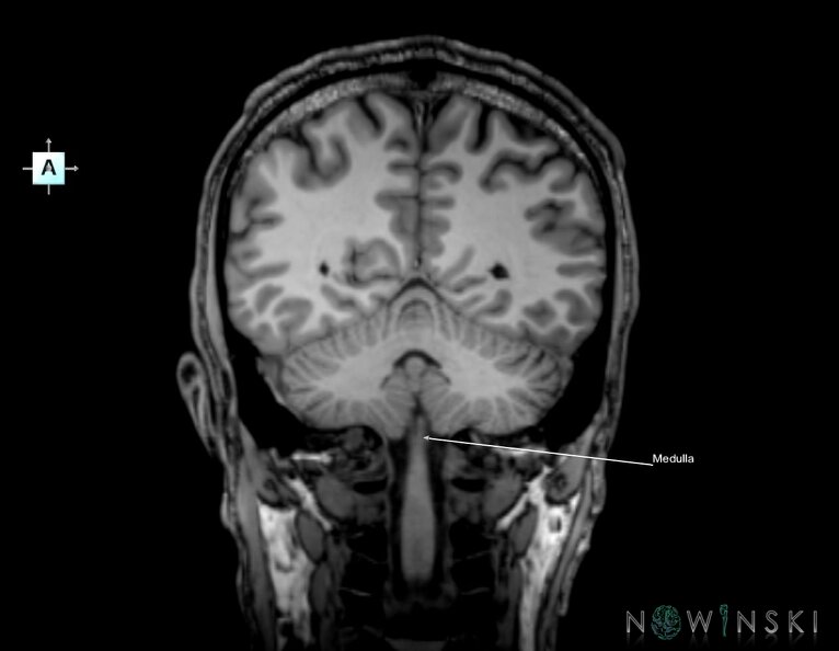G6.T9.4.V1.P-50.Brainstem–Triplanar.tiff